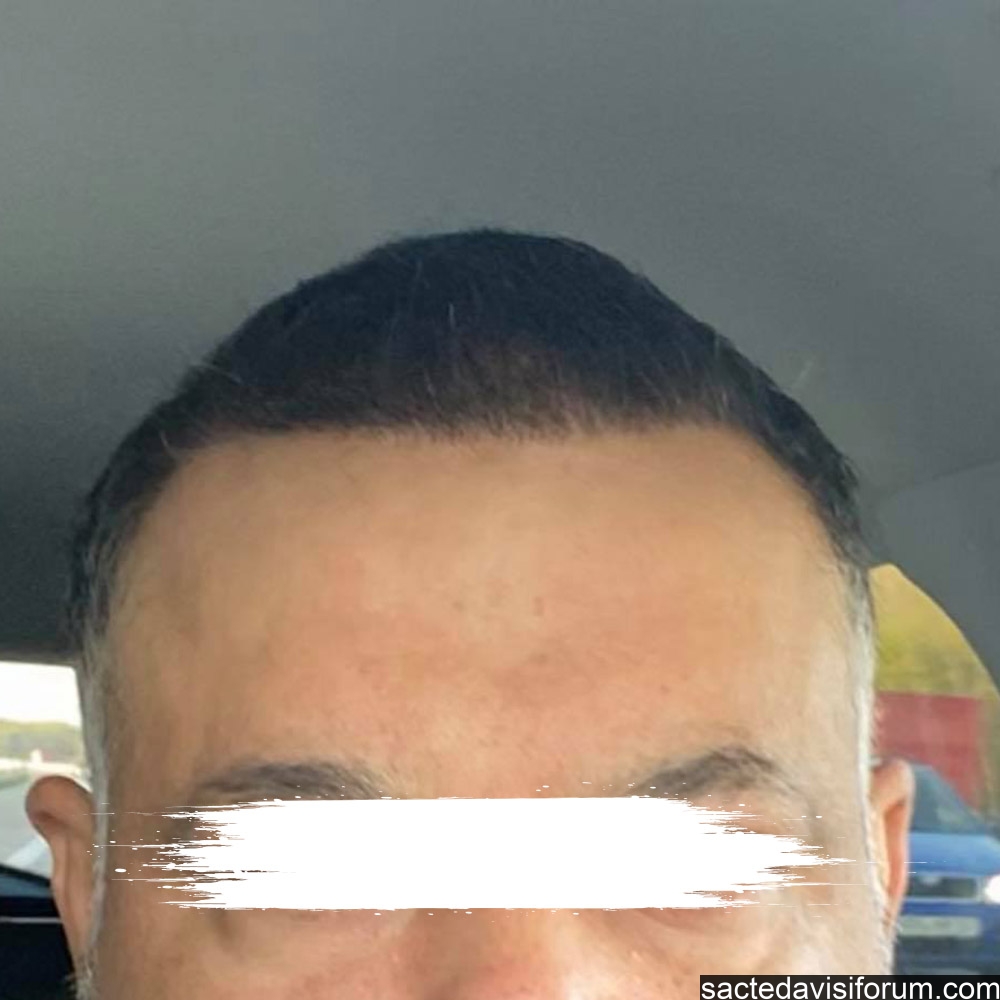 5400 kök saç ekimi.jpg