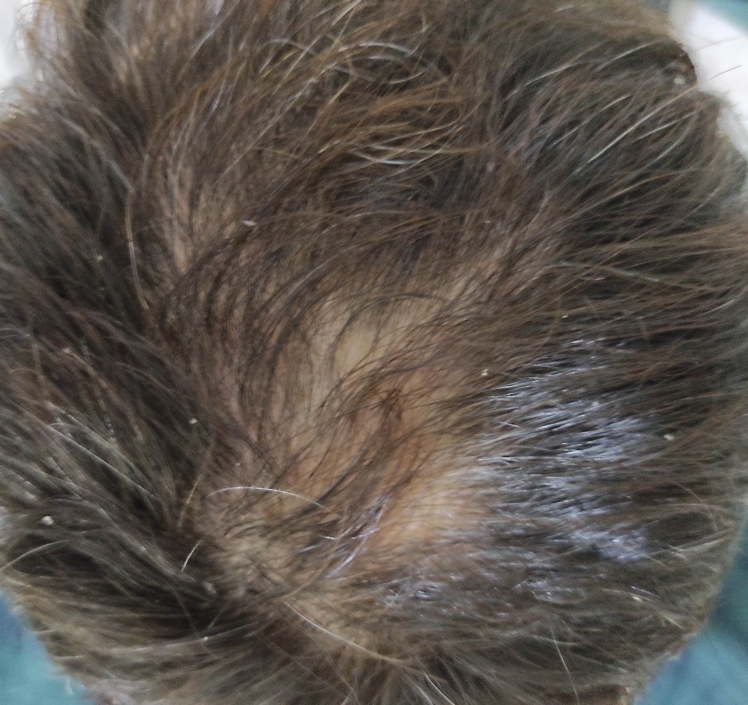 Asuman hair transplant 3800 greft saç ekimi.jpg