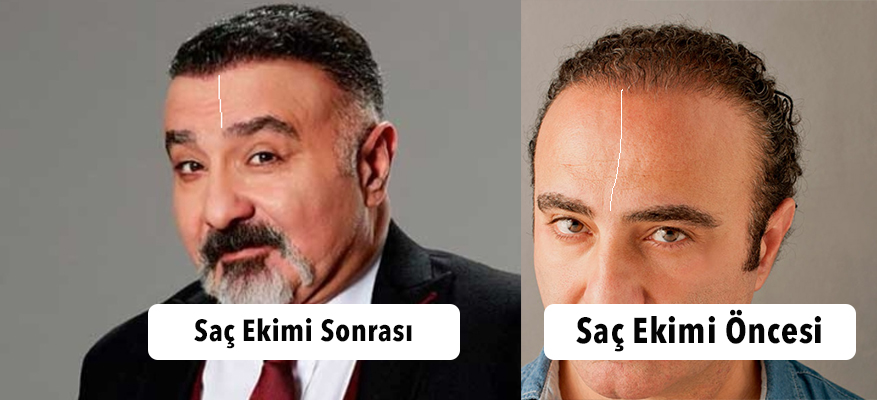 cengiz bozkurt saç ekimi .jpg