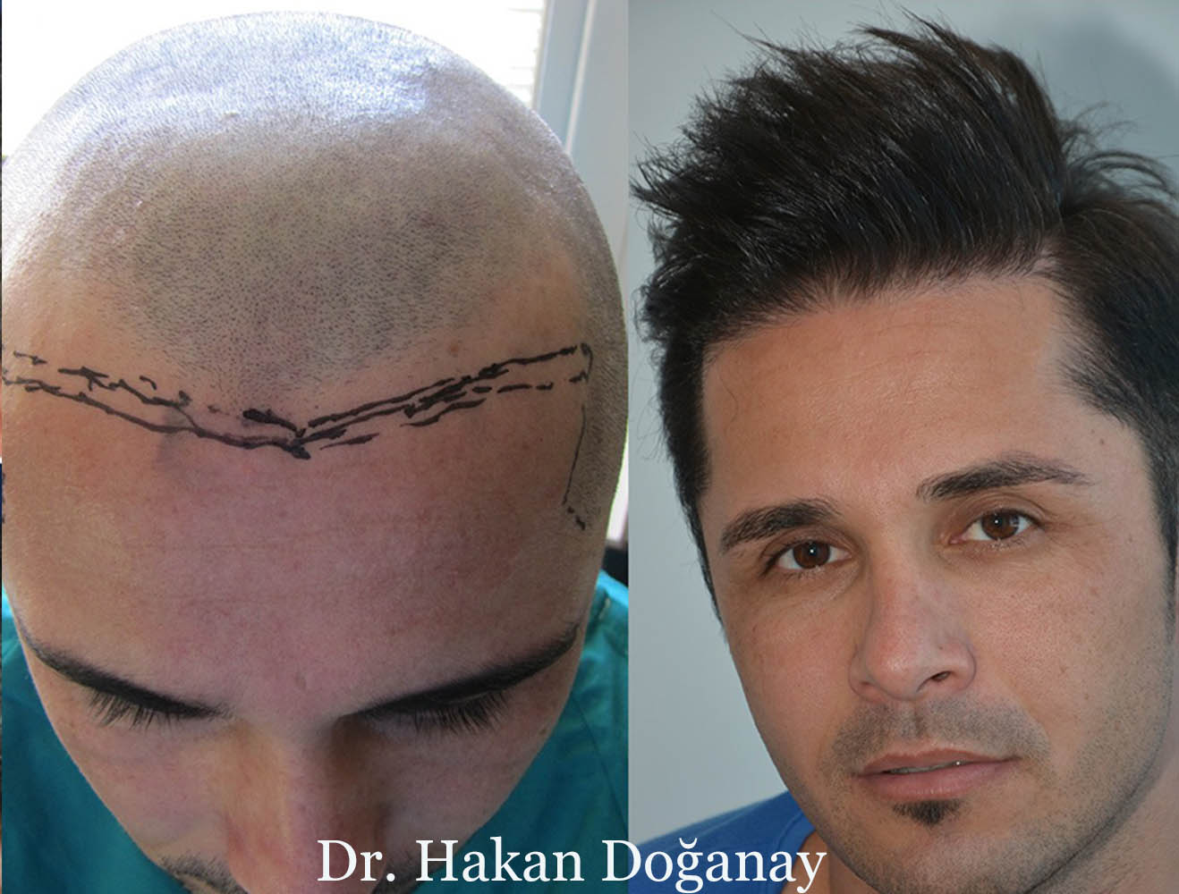 Dr. Hakan Doğanay Saç Ekimi.jpg