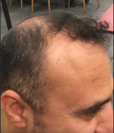 estemiami saç ekimi öncesi.png