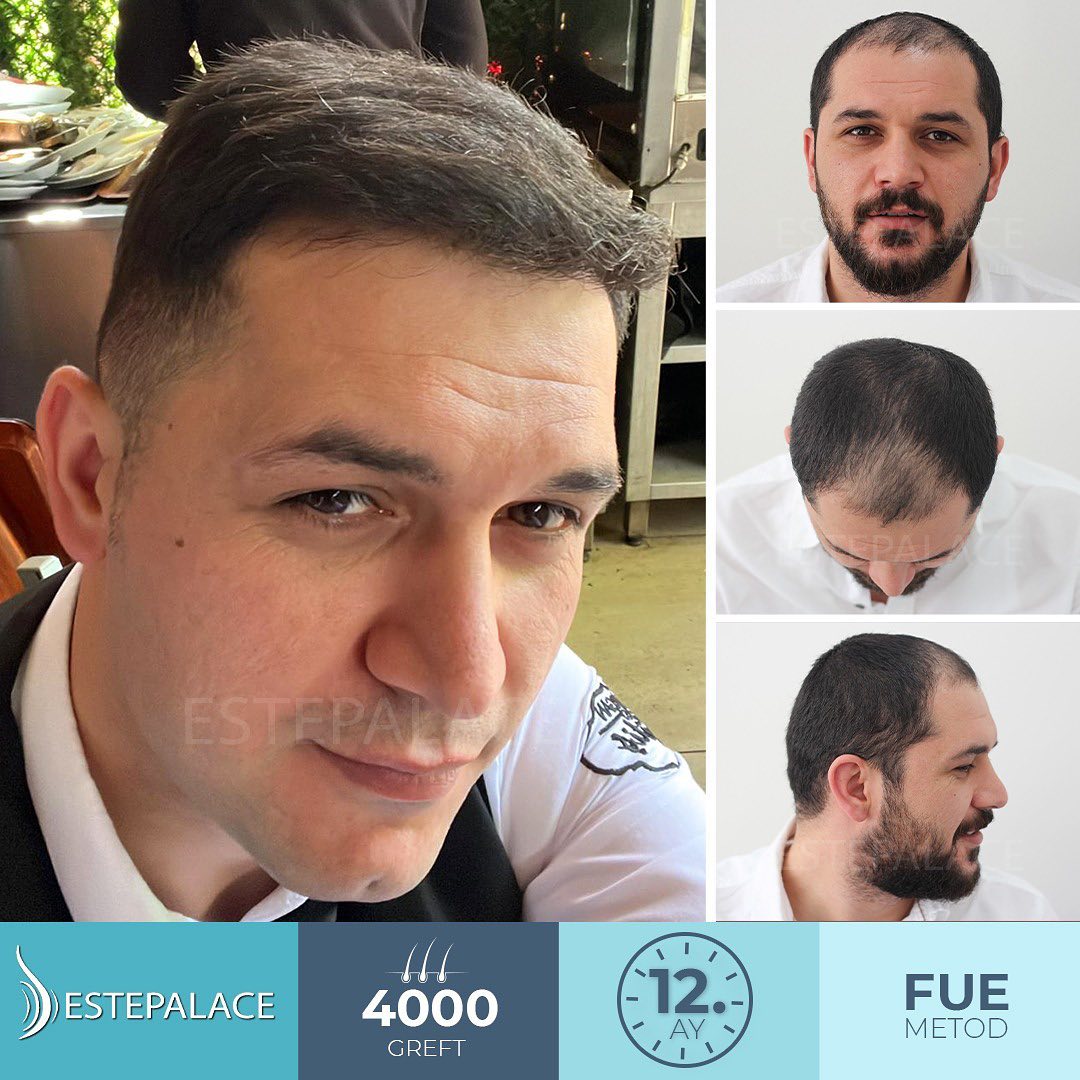 Estepalace saç ekimi.jpeg