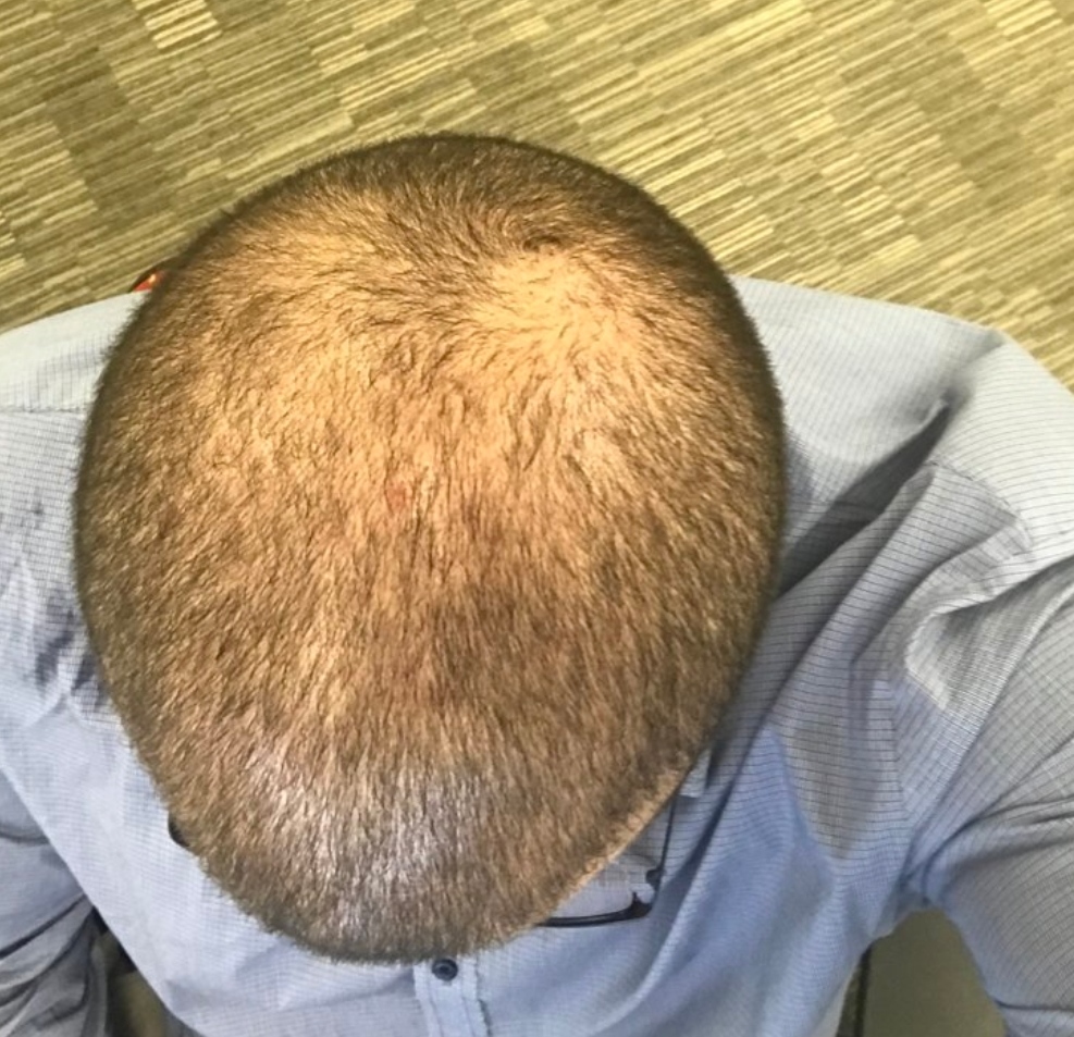 Hermest Hair Clinic Saç Ekimi Yorumları