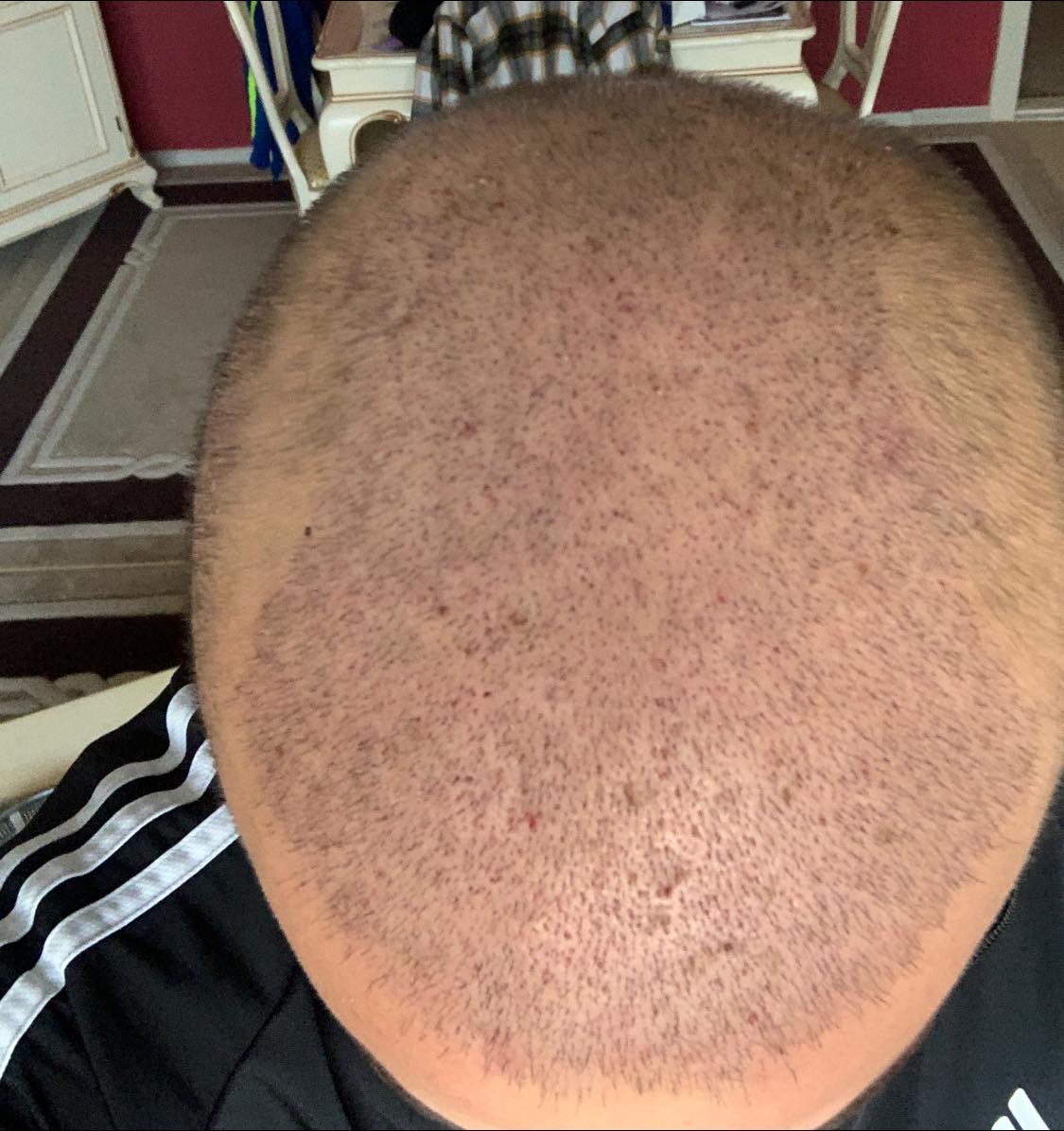 hüseyin örs saç ekimim.jpeg