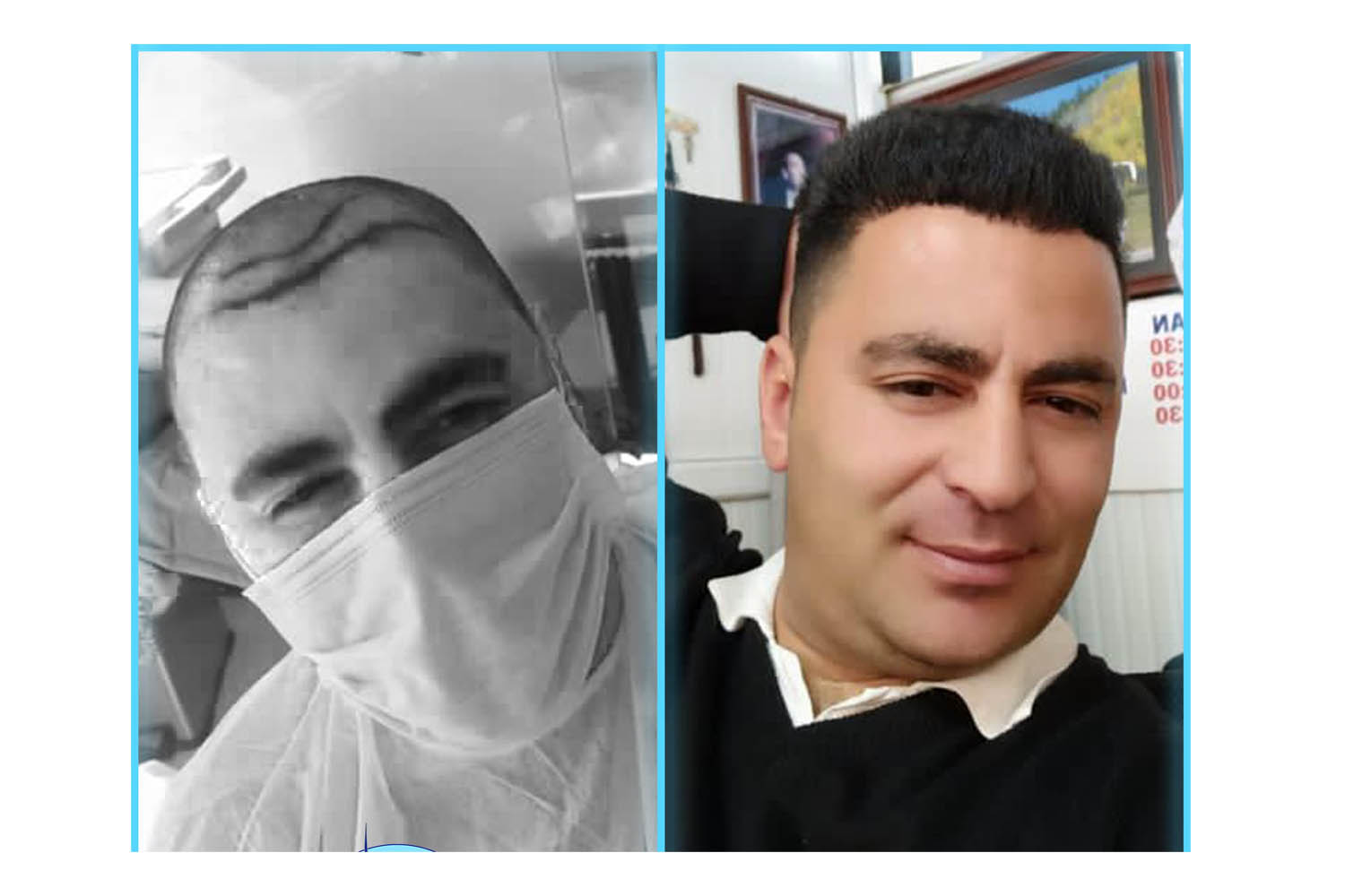 liv hospital saç ekim sonuçları.jpg