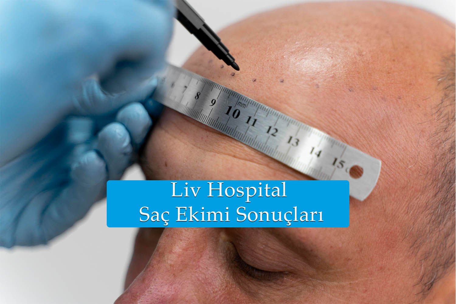 liv hospital saç ekimi sonuçları.jpg