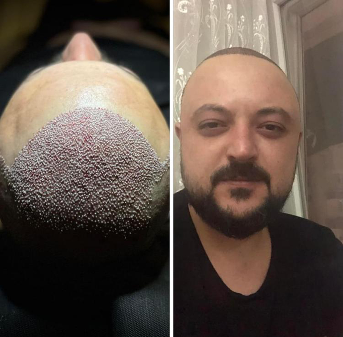 murat makascı saç ekimi.jpg