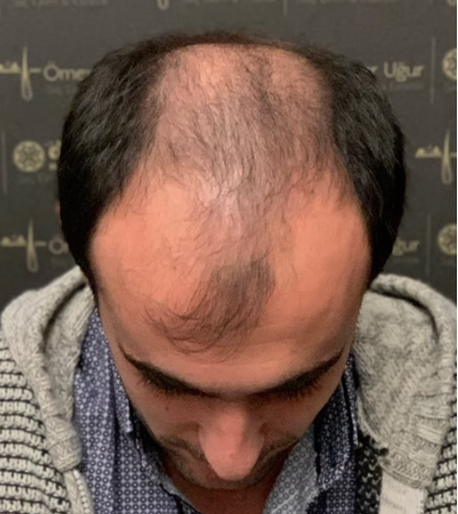 Ömer Uğur saç ekimii.png