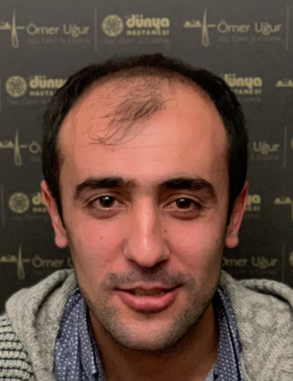 ömer uğur saç.png