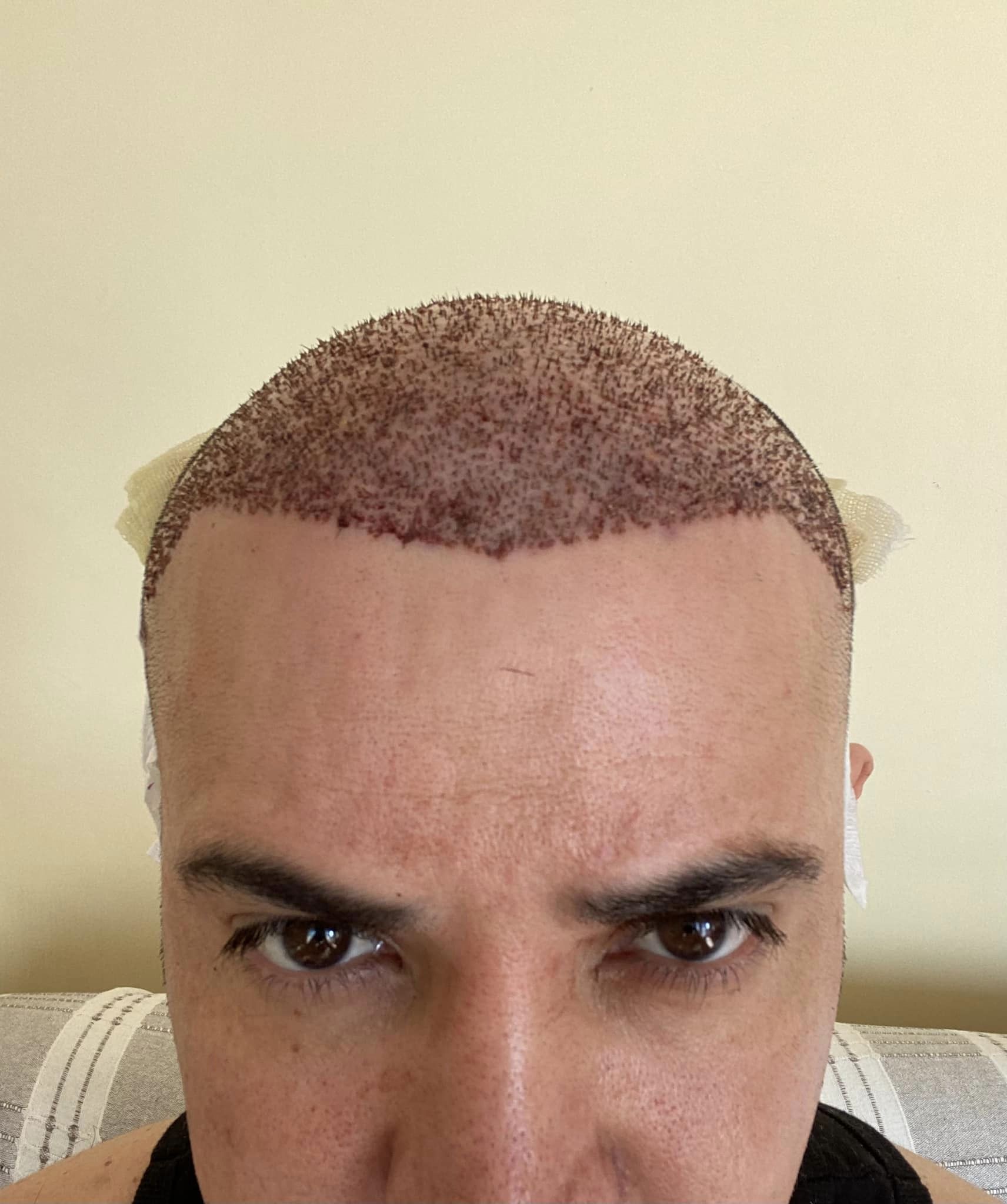 ossi hair saç ekimi.jpeg