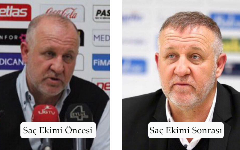 Saç ekimi.jpg