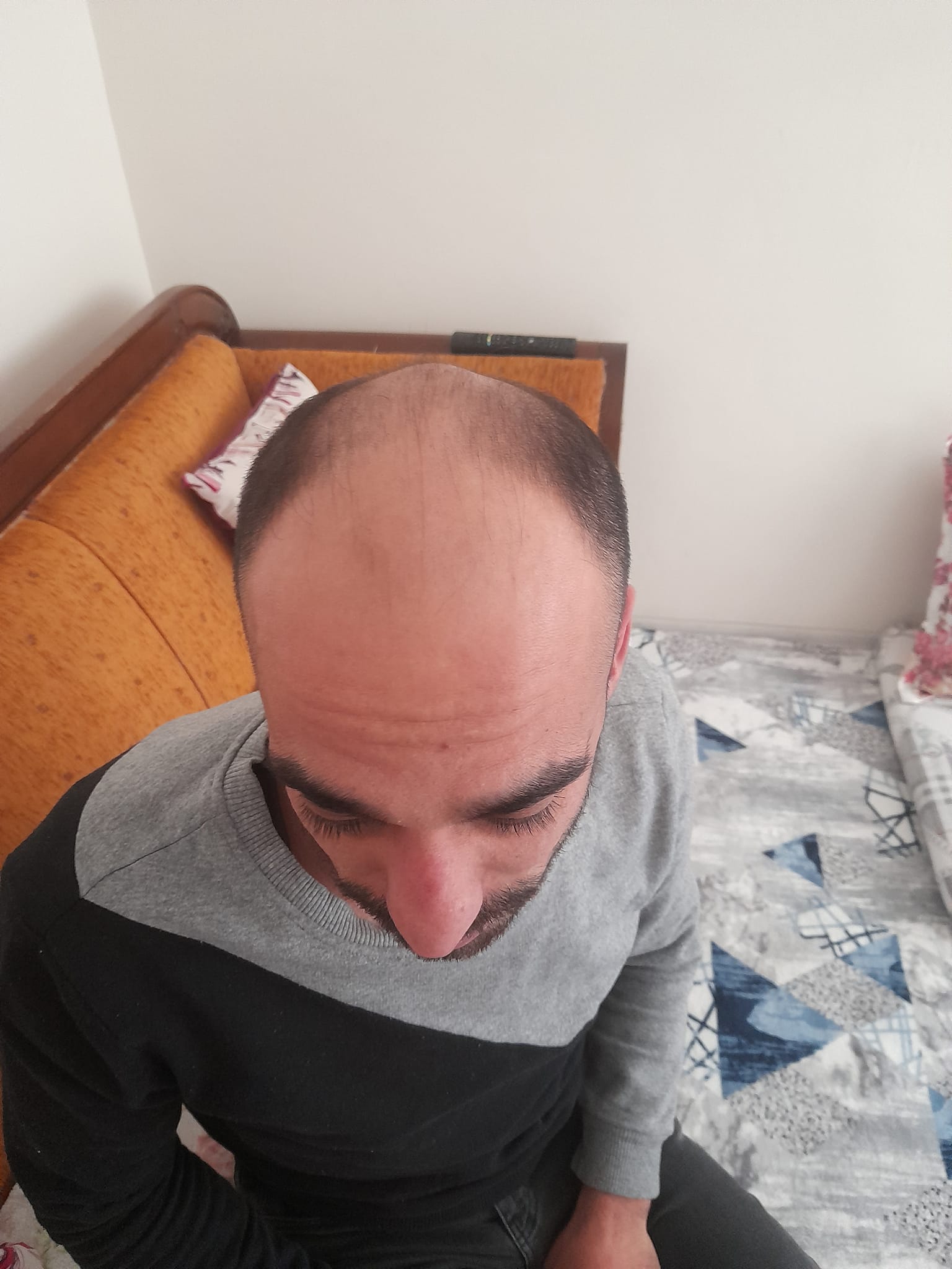 saç ekimi öncesi.jpeg