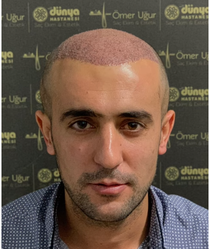 saç ekimi ömer.png