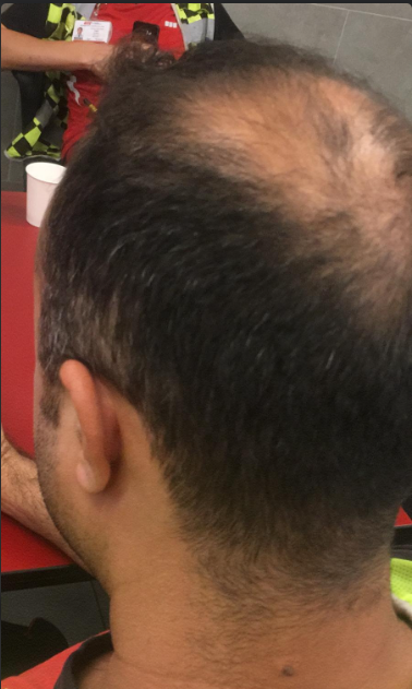 saç ekimi öncesi.png