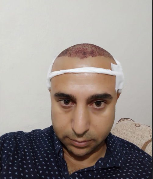 saç ekimi sonrası 2.png
