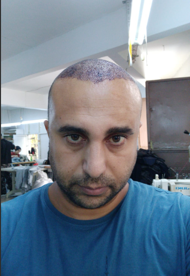 saç ekimi sonrası 3.png