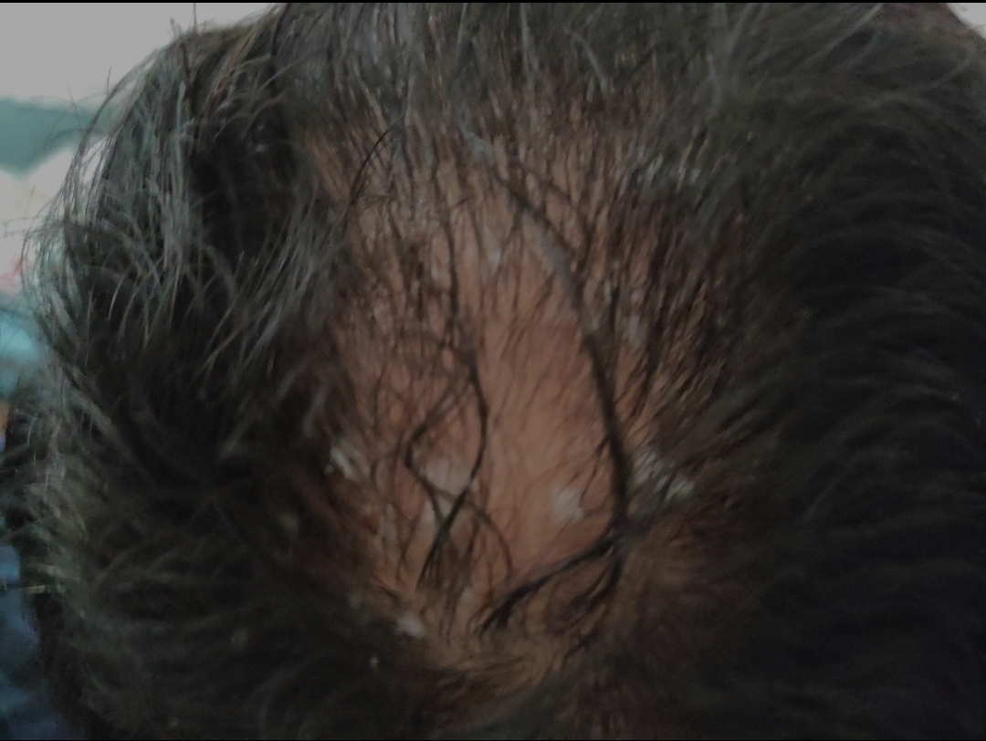 Seboreik Dermatit Nedeniyle Dökülen Saçlar Tekrar Çıkar mı.jpg