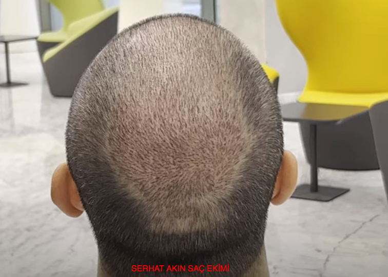 SERHAT AKIN SAÇ EKİMİ.png