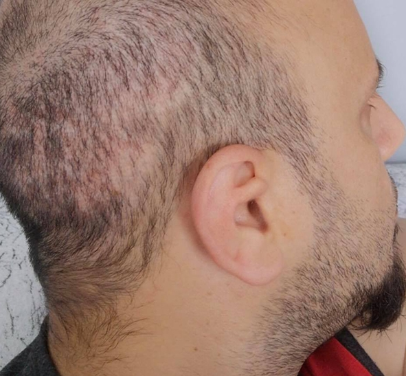 serkan aydın donör bölge.png