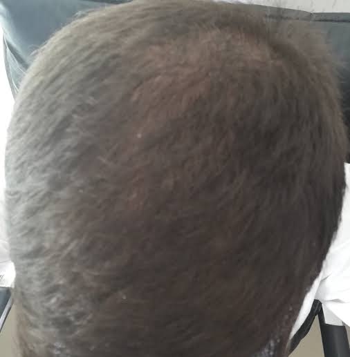 Tepe bölgesi saç dökülmesi