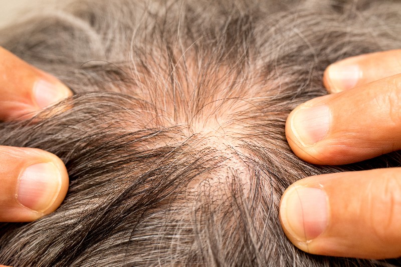 vecteezy_older-man-with-thinning-hair-on-the-back-of-his-head-around__794_copy_800x533.jpg